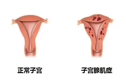 我有子宫腺肌症，可以做试管婴儿吗？(图1)