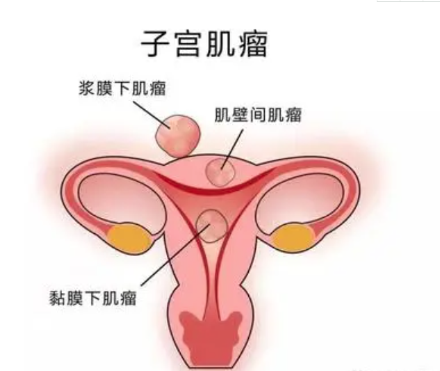 茂名市有子宫肌瘤的可以做试管婴儿吗？(图1)
