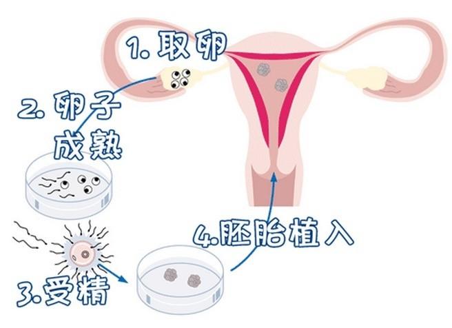 试管婴儿IVF过程分为哪几个阶段?试管婴儿过程(图1)