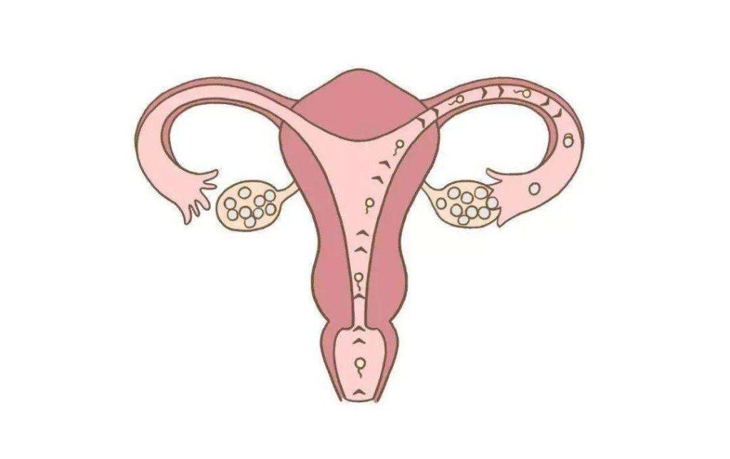 单侧卵巢能否做试管婴儿？(图1)