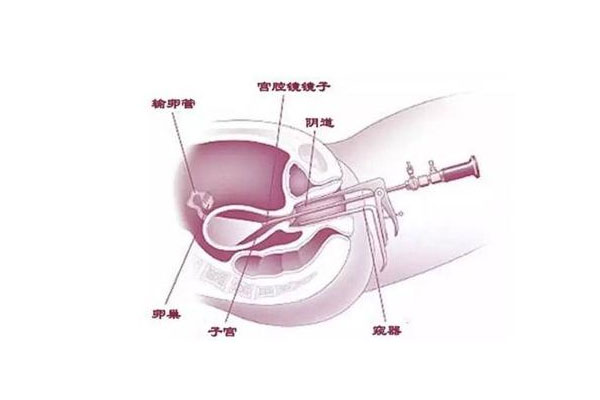 宫腔镜检查和输卵管造影哪个疼