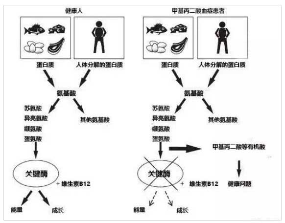 甲基丙二酸血症