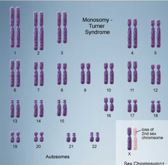 特纳综合症染色体核型