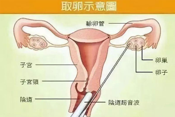 史上最全取卵过程