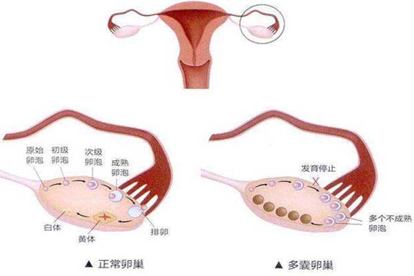 多囊卵巢与运动的关系