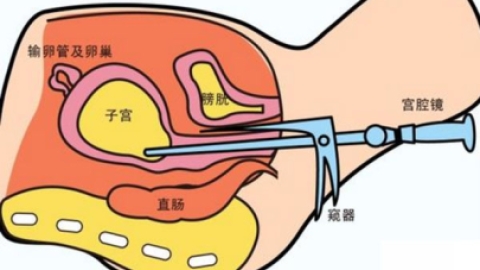 宫腔镜手术后调养方法