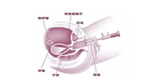 宫腔镜检查和输卵管造影哪个疼