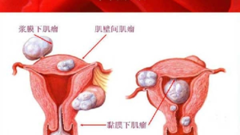 子宫肌瘤患病率达25%，是否影响试管婴儿怀孕成