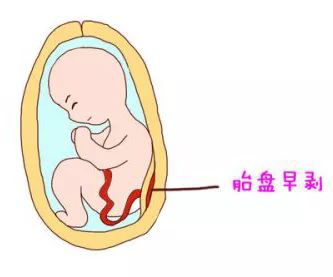 胎盘早剥是什么原因引起的?