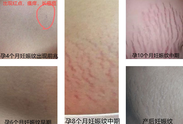 开始长妊娠纹的先兆图-专家揭秘妊娠纹的预防和