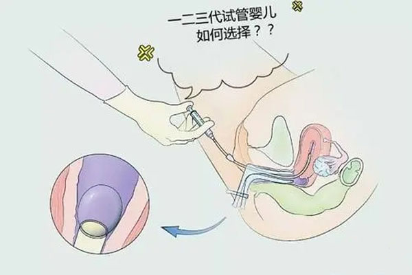 一代、二代、三代试管婴儿有什么区别?各多少钱?
