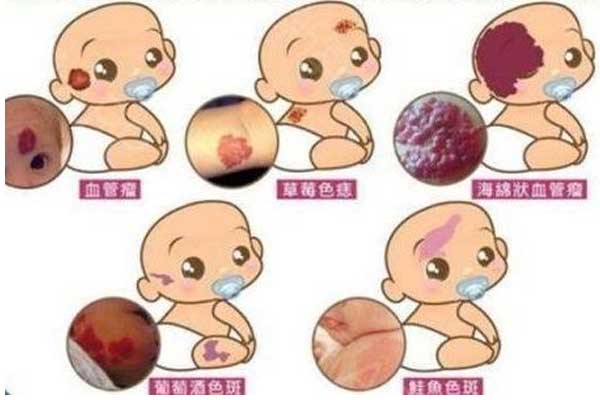 血管瘤会遗传吗？三代试管婴儿能否完全筛查？