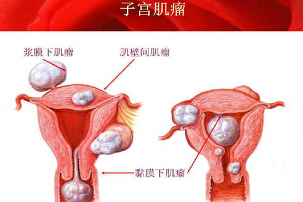 子宫肌瘤患病率达25%,是否影响试管婴儿怀孕成