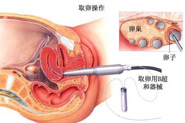 做试管婴儿取卵到底有多痛?别怕痛,做好这几