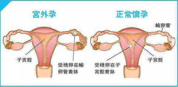 试管婴儿出现"宫外孕",三胞胎变为双胞胎
